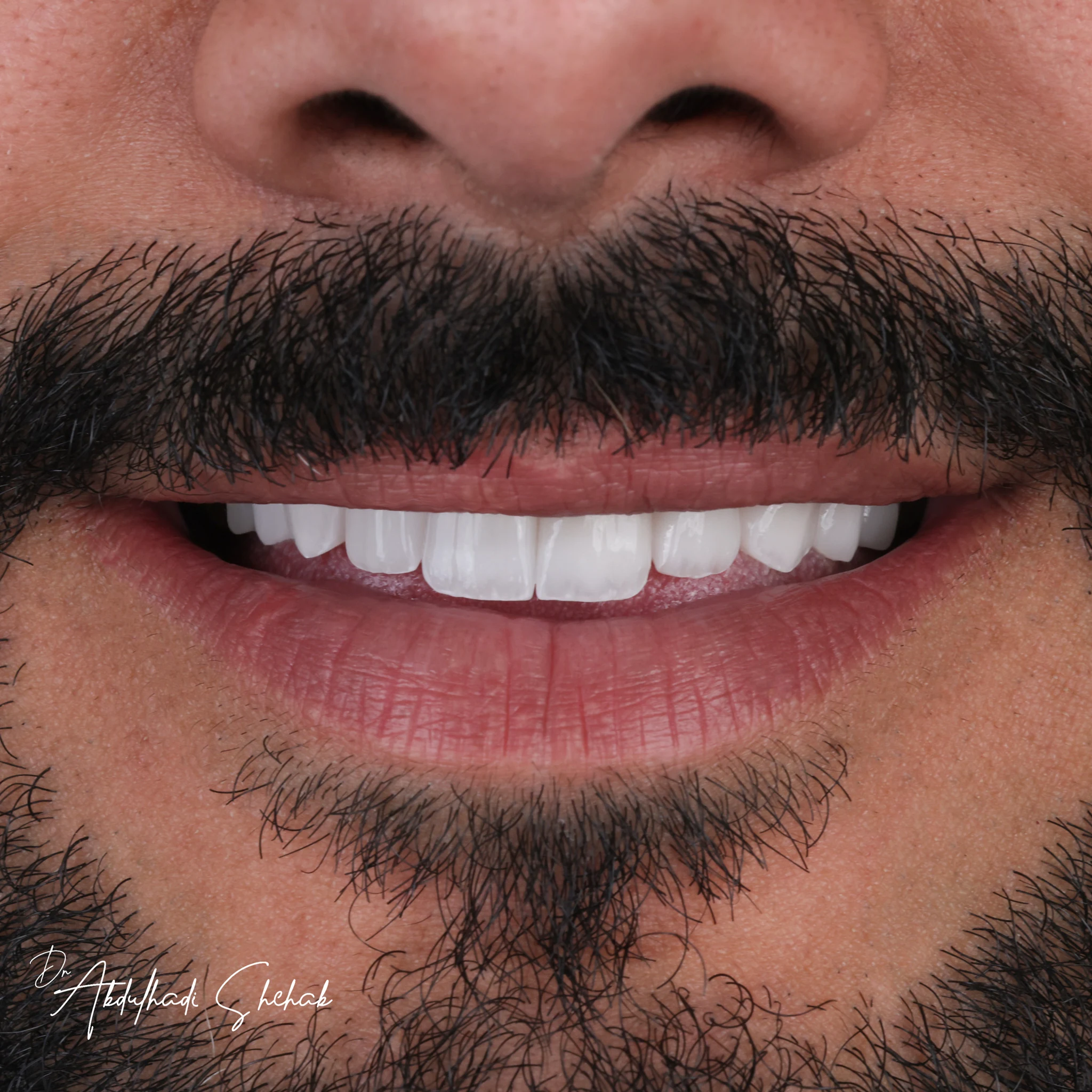 Veneers
